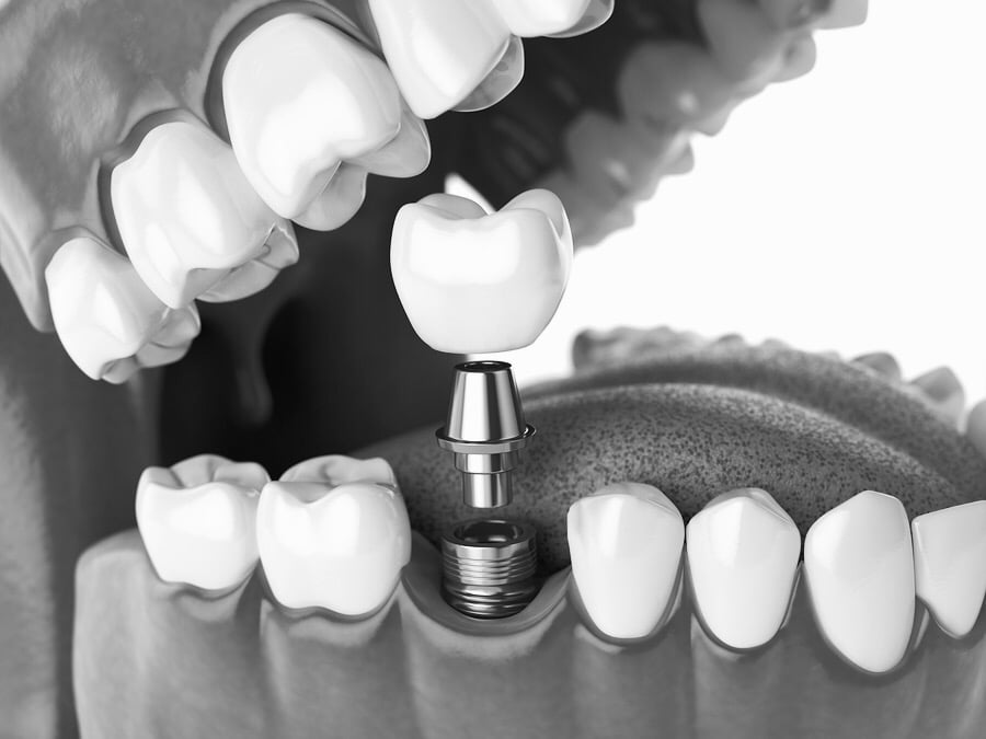 dental implants limerick