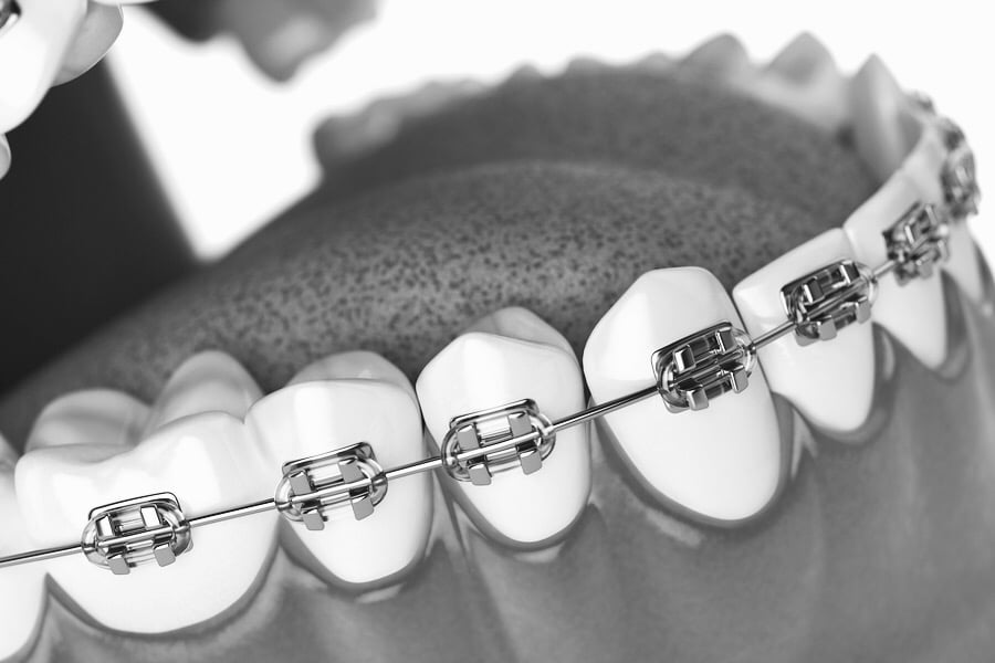 Teeth with metal braces