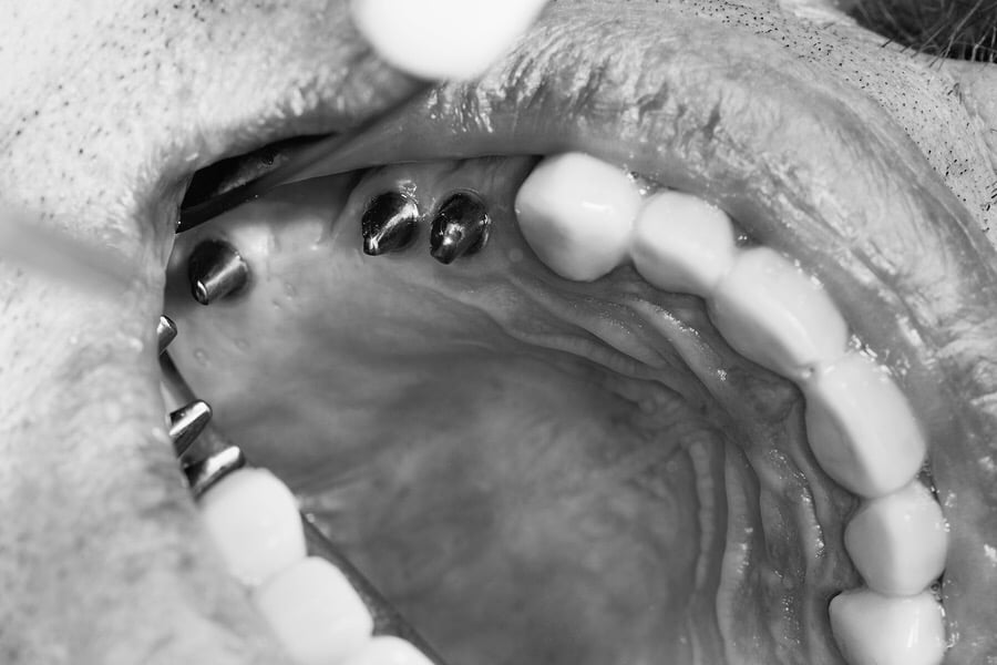 Dental implants in mouth before bonding the metal ceramic bridge.