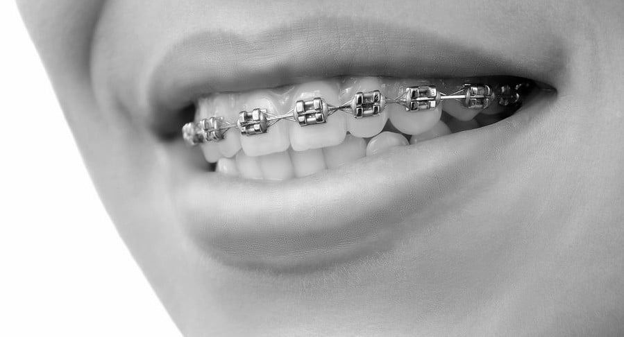 Orthodontic Treatment - Patient Review - Dental braces