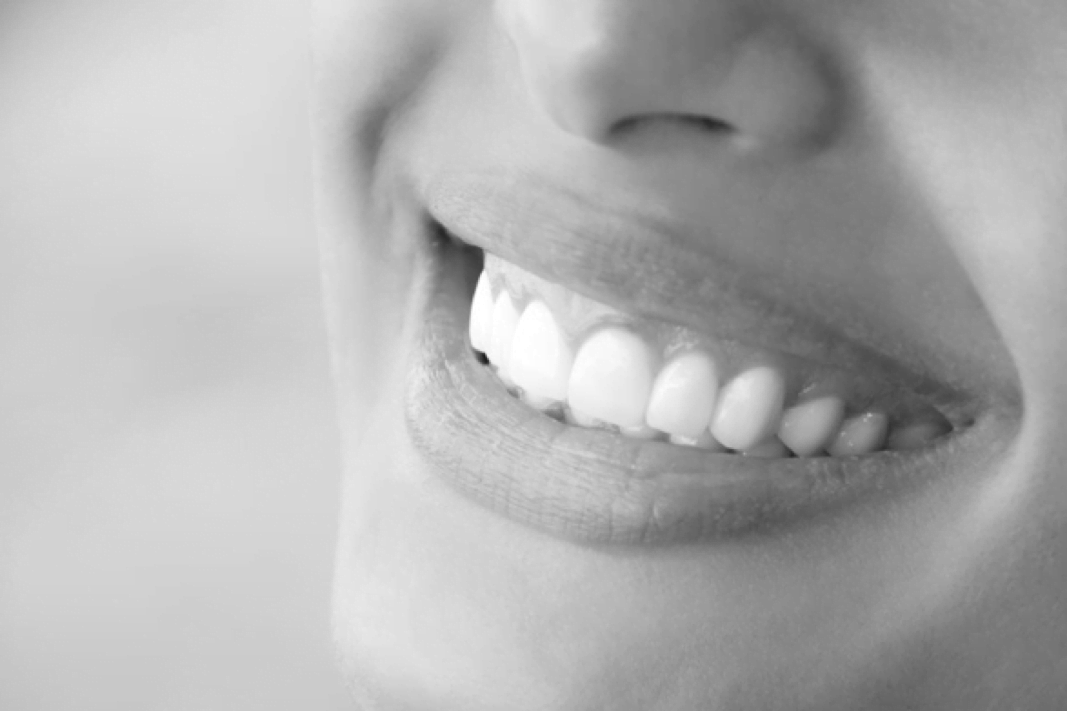 pros and cons of veneers