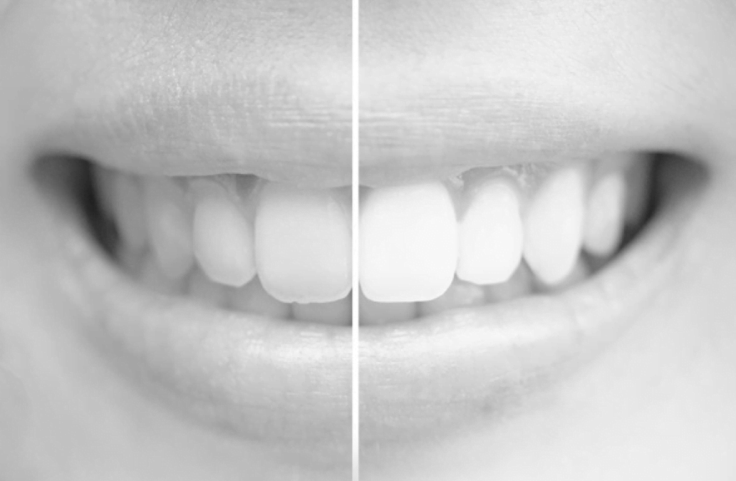 Why are My Teeth Yellow? A Guide for Yellow Teeth and Brighter Smiles