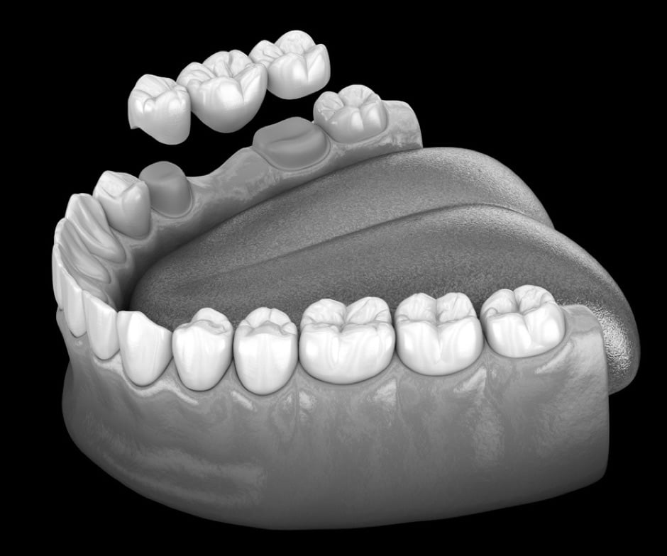 dental bridge depiction