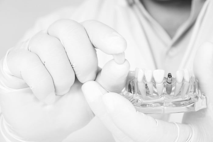 dental implants v dentures
