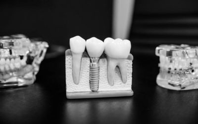 Here’s Why You Should Consider Dental Implants